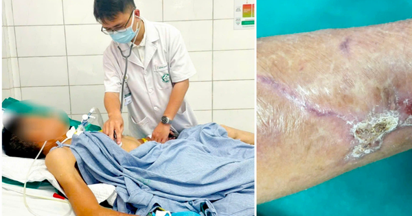 Người đàn ông 65 tuổi co giật, cứng hàm sau cú ngã đập tay vào thanh gỗ