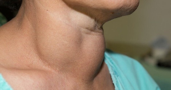 3 dấu hiệu quan trọng cảnh báo ung thư tuyến giáp, nếu xuất hiện 1 trong 3, cần đi khám ngay