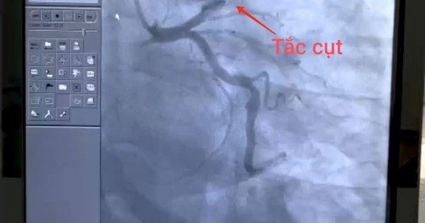 Người đàn ông 43 tuổi đột ngột nhồi máu cơ tim ngay trên đường đi làm thừa nhận có thói quen này