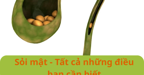 Sỏi mật - Tất cả những điều bạn cần biết