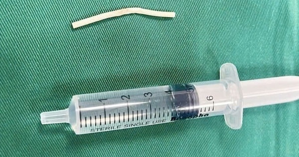 Người phụ nữ 35 tuổi ở Hải Dương phải phẫu thuật vì que tránh thai 'đi lạc' trong cánh tay