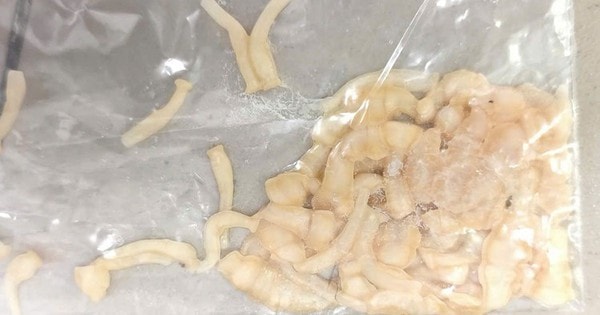 Nam thanh niên 30 tuổi ở Phú Thọ có sán dây dài hơn 3 mét do thường xuyên ăn món quen thuộc này