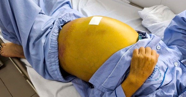 Người phụ nữ 61 tuổi suy gan nặng, nguy cơ tử vong cao do chủ quan với dấu hiệu này