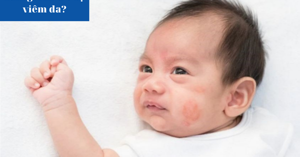 Làm gì khi trẻ bị viêm da?