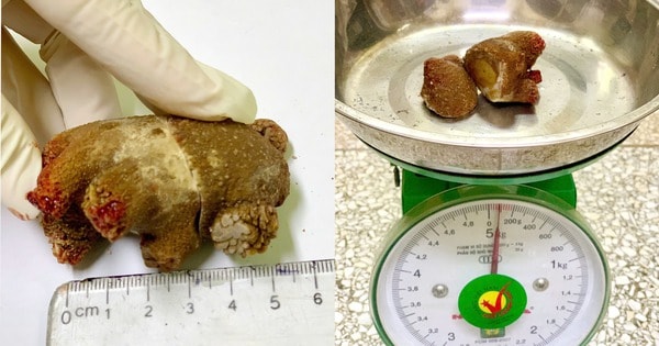 Người đàn ông 46 tuổi ở Quảng Ninh có sỏi thận 'khủng' như san hô do mắc sai lầm này trong nhiều năm