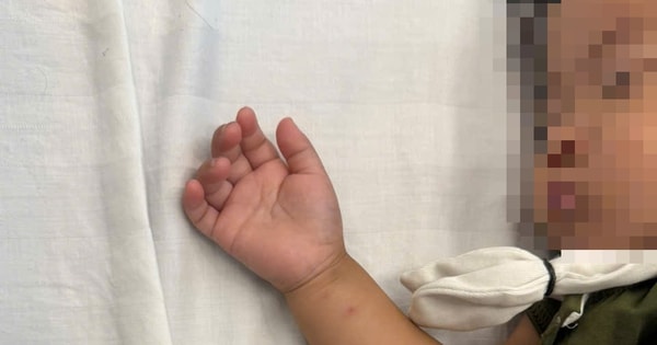 Bé gái hơn 2 tuổi nhập viện gấp do tai nạn tại nhà hay gặp ở trẻ nhỏ