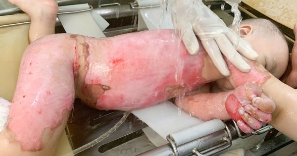 Bé 2 tuổi bỏng 60% được cứu sống nhờ ghép da từ mẹ