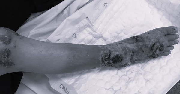 Những cách chữa bệnh xương khớp khiến bác sĩ phải 'lắc đầu' ngao ngán