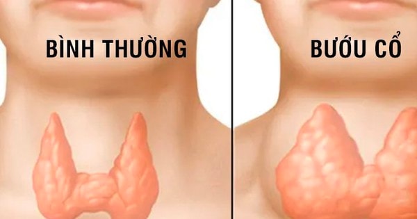 Thiếu i-ốt gây hại như thế nào?