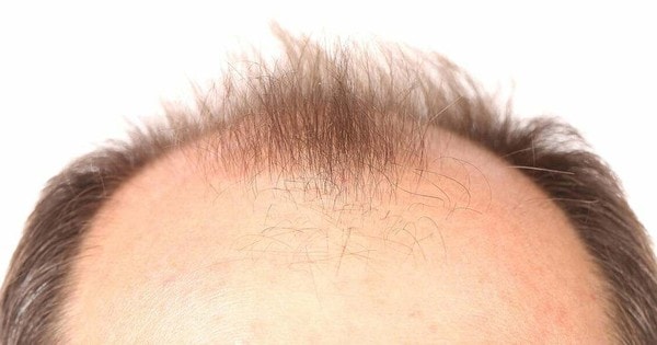 Đồ uống có đường - 'thủ phạm' gây rụng tóc ở nam giới