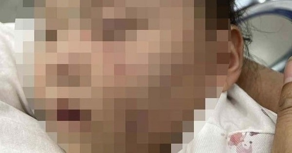 Đón con từ nhà trẻ về có nhiều vết bầm tím trên người: Tạm giữ bảo mẫu để điều tra