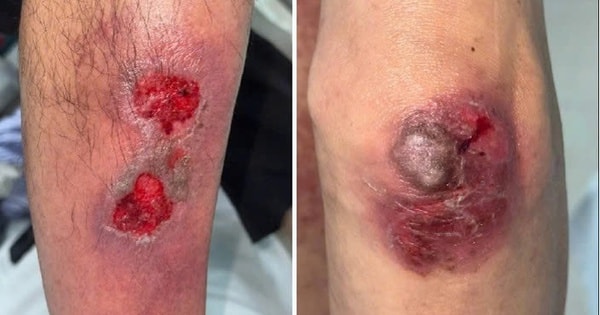 Uống sai liều thuốc da liễu, nhiều người ngộ độc nặng