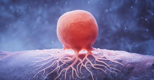 Giảm chất béo có thể 'bỏ đói' tế bào ung thư vú