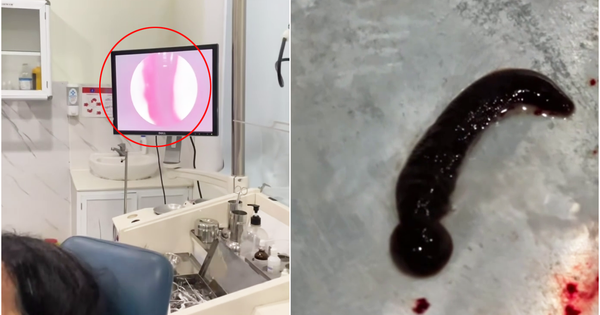 Hãi hùng con đỉa 6 cm sống trong mũi cụ bà suốt 3 tuần