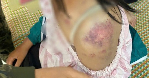 Những vết thương chi chít trên cơ thể của cô bé bị bạo hành