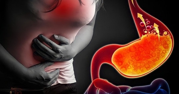 Có nên dùng men vi sinh giảm chứng trào ngược axit dạ dày?