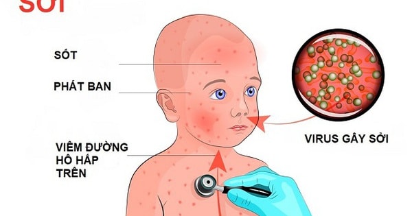 Tự ý dùng kháng sinh khi mắc sởi có thể làm bệnh nặng hơn