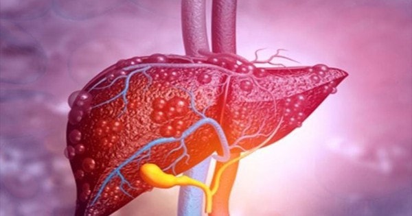 Bệnh gan nhiễm mỡ, hay gặp nhưng nguy hiểm