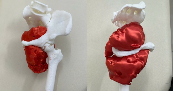 Cứu sống bệnh nhân ung thư hiếm gặp bằng phẫu thuật tháo nửa khung chậu