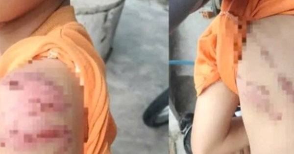 Công an điều tra vụ bé trai nghi bị cha ruột đánh