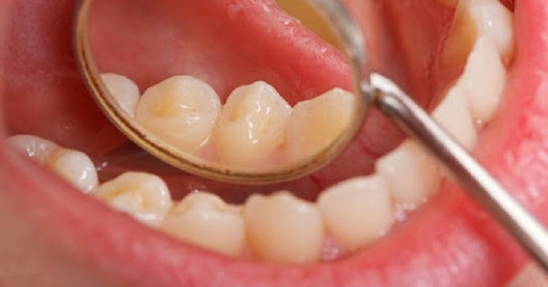 Ngoài thuốc lá, yếu tố nào làm tăng nguy cơ ung thư khoang miệng?