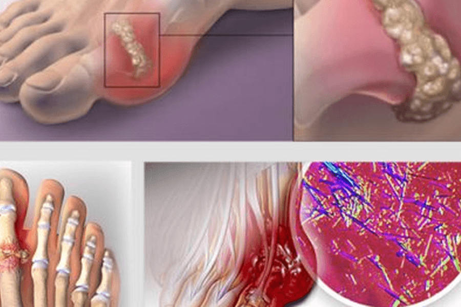 Bị bệnh gout có nên ăn cá?