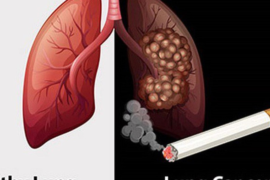 70-80% bệnh nhân ung thư phổi tại Việt Nam được chẩn đoán ở giai đoạn muộn